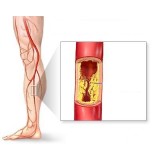 Venous Problems