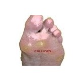 Calluses - Hard Feet